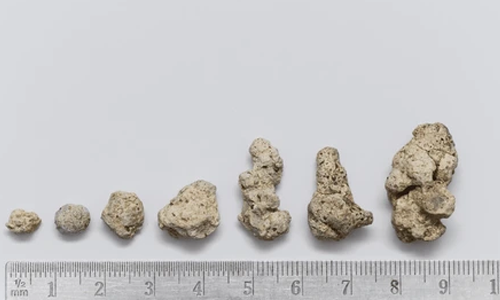 Calcium-Stones