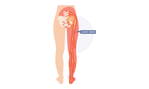 Understanding-the-Sciatic-Nerve
