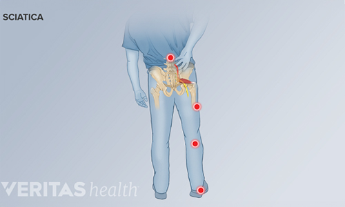 What-is-Sciatica