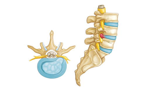 Herniated-Disk