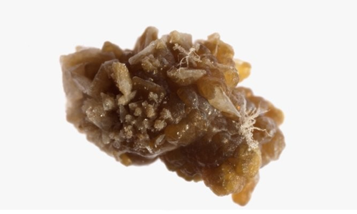 Uric-Acid-Stones