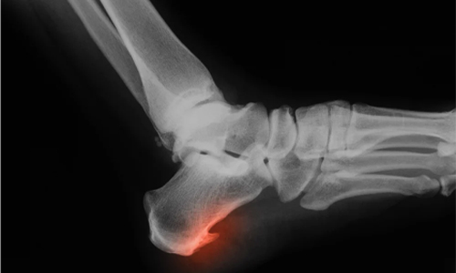 Bone-Spurs