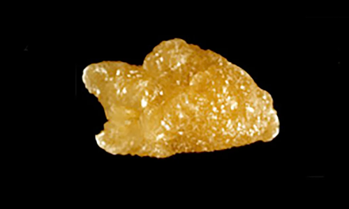 Cystine Stones