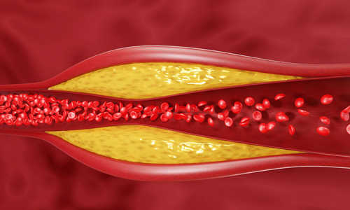 Managing-Cholesterol