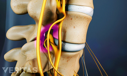 Spinal-Stenosis