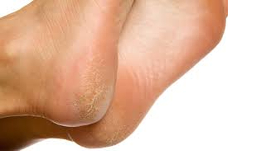 Heal heels