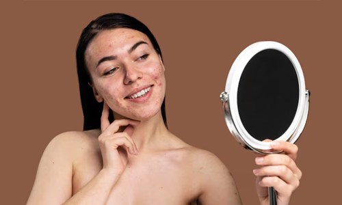 Reduce acne