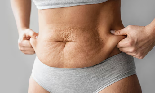 Stretch marks