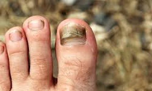 Toenail fungus