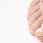 Toenail Fungus: Symptoms, Causes, Diagnosis & Cure