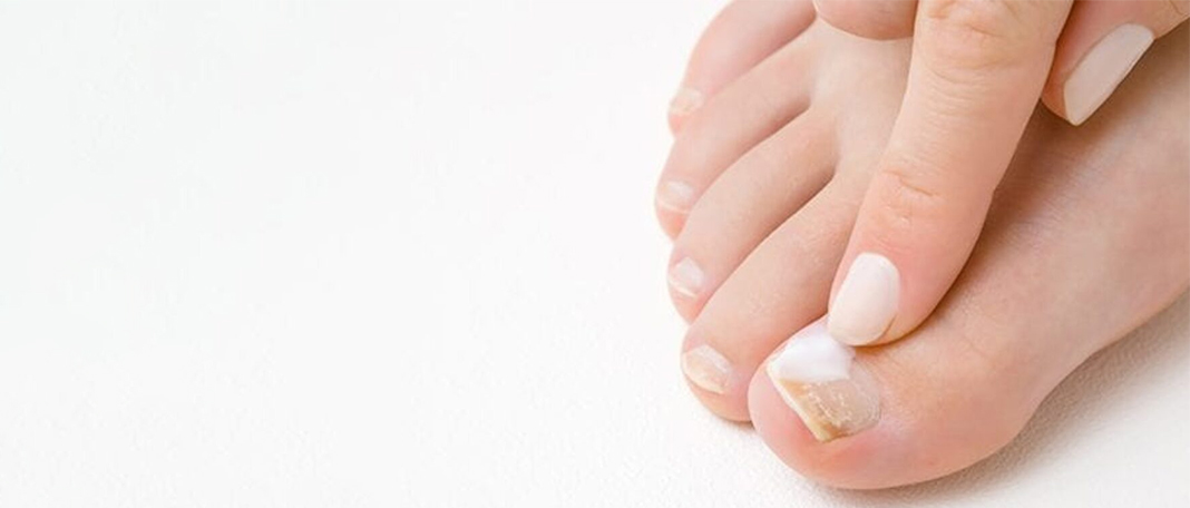 Toenail Fungus: Symptoms, Causes, Diagnosis & Cure