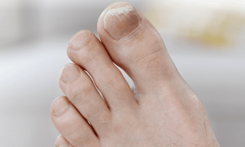 What is Toenail Fungus