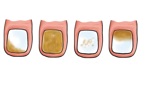 Different Types of Toenail Fungus