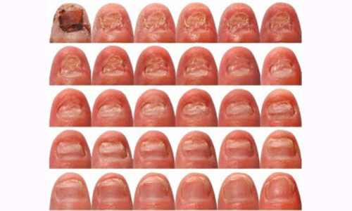 Stages of Toenail Fungus