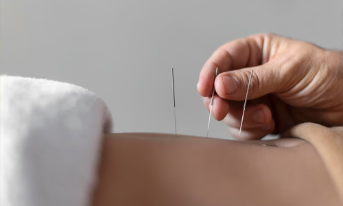 Acupuncture