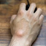 Sarcoma : Types, Symptoms, Causes, Stages, Treatment
