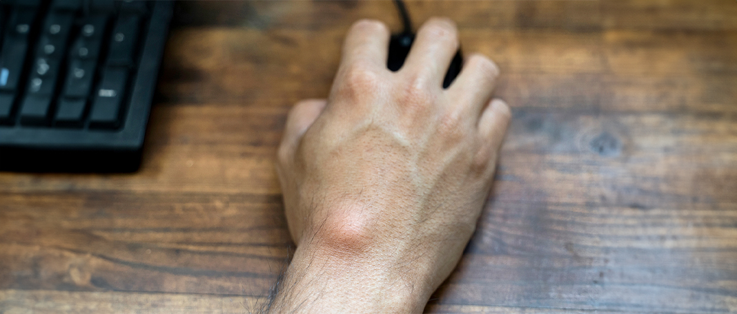 Sarcoma : Types, Symptoms, Causes, Stages, Treatment