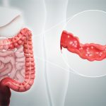 What is Ulcerative Colitis?
