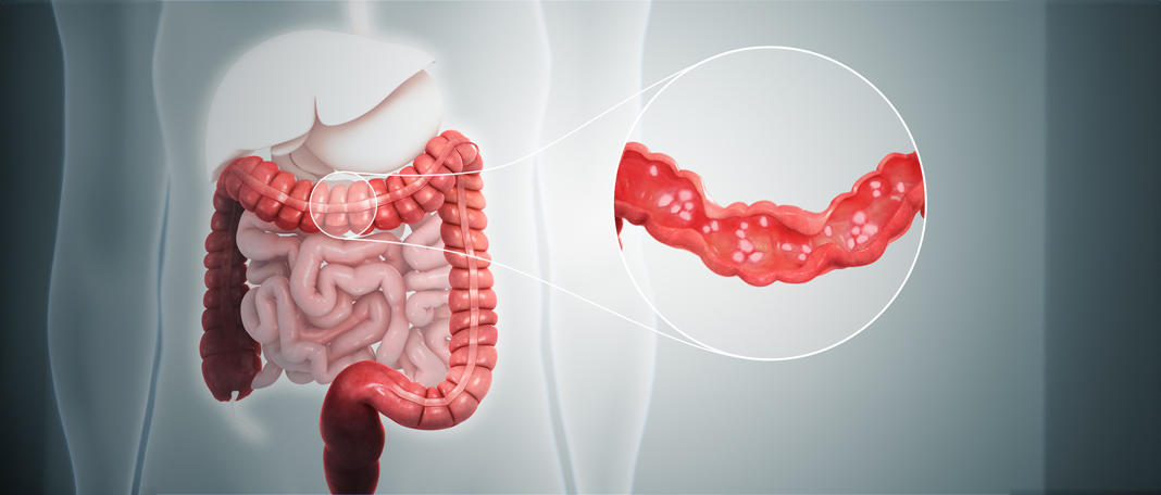 What is Ulcerative Colitis?