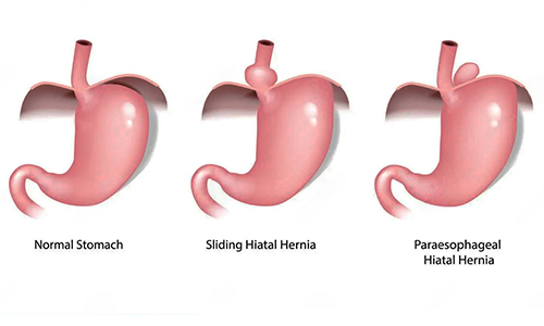 Types-of-Hiatal-Hernia