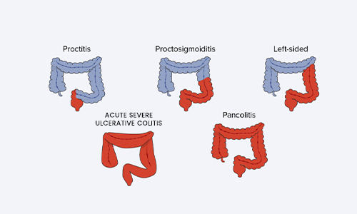Types-of-Ulcerative-Colitis