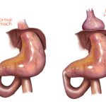 Hiatal Hernia Types, Symptoms, and Prevention
