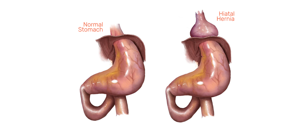 Hiatal Hernia Types, Symptoms, and Prevention