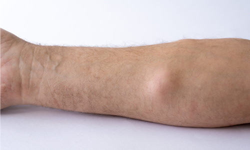 Liposarcoma
