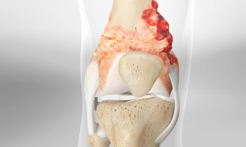 Osteosarcoma