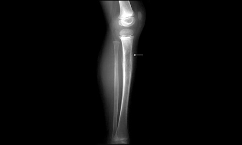 Ewing Sarcoma