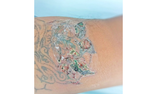 Skin-infections