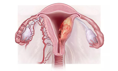  Leiomyosarcoma