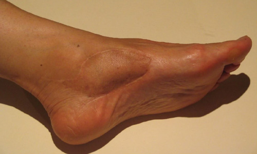 Synovial Sarcoma