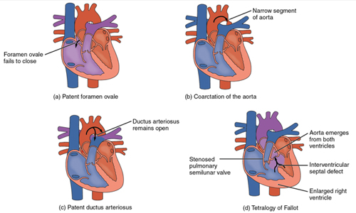Congenital Heart Defects