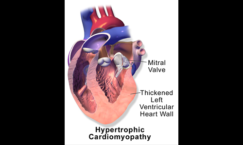 Hypertrophic Cardiomyopathy
