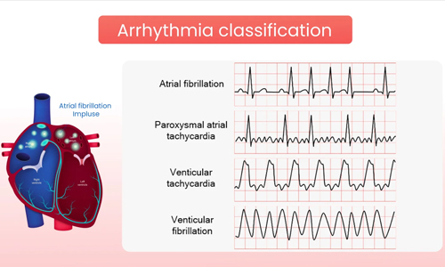 Arrhythmias