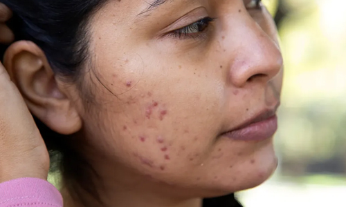 Heals-acne-and-rashes