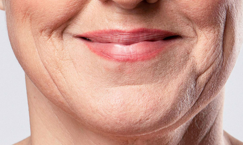 Wrinkles