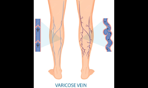 What are Varicose Veins