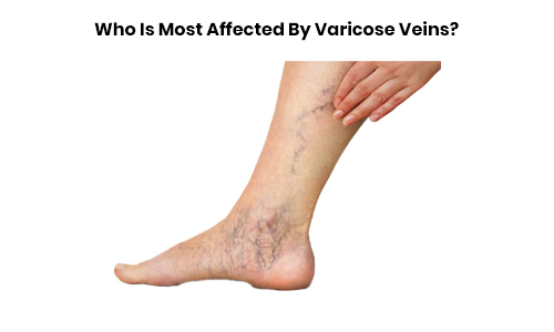Who Is Most Affected By Varicose Veins