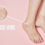 How to Get Rid of Varicose Veins