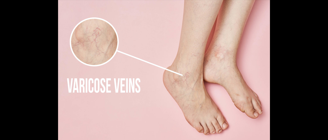 How to Get Rid of Varicose Veins
