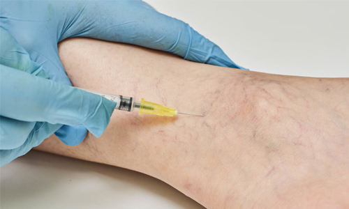 Sclerotherapy