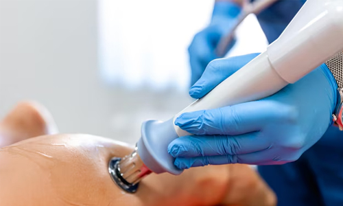Endovenous Ablation Therapy