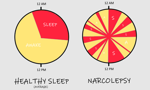 Normal Sleep Cycle vs. Narcolepsy Sleep Cycle