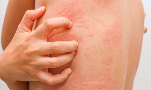 Hives