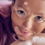 How To Reduce Melanin In Skin Naturally