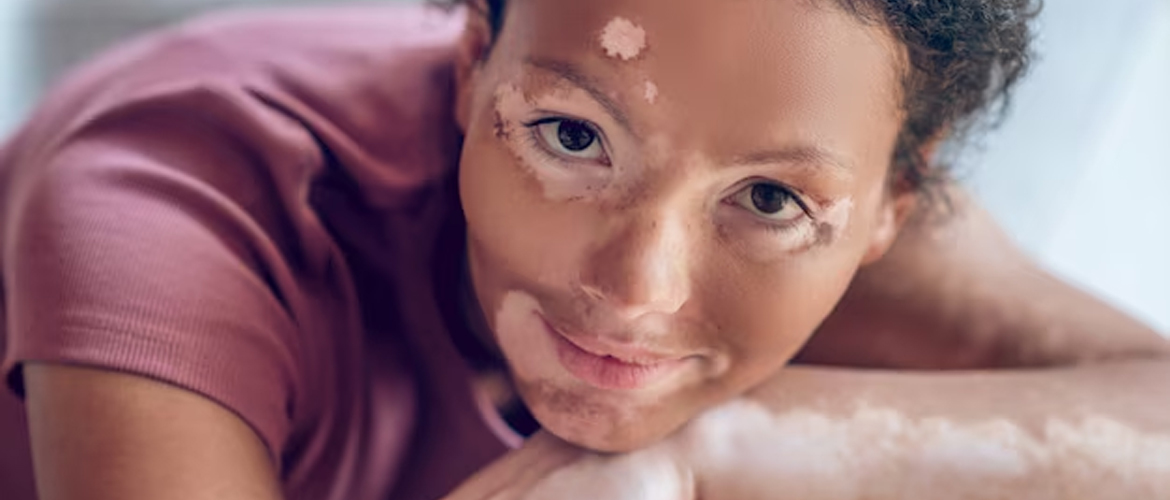 How To Reduce Melanin In Skin Naturally