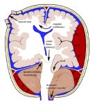 Brain Herniation: Types, Symptoms, and Treatment