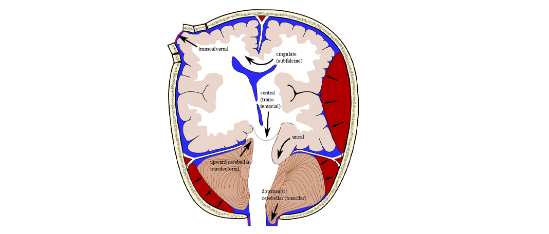 Brain Herniation: Types, Symptoms, and Treatment